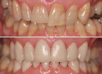 Porcelain Veneers