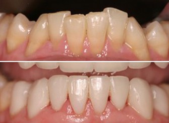 Porcelain Veneers