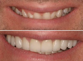 Porcelain Veneers