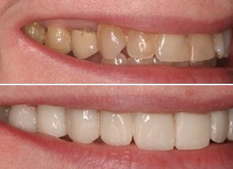 Porcelain Veneers