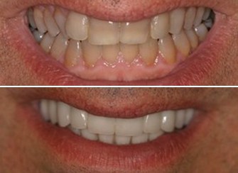 Porcelain Veneers