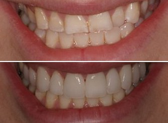 Porcelain Veneers