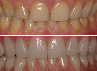 Porcelain Veneers