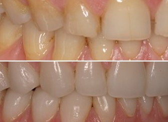 Porcelain Veneers