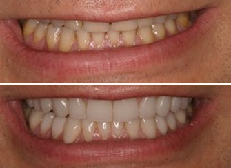 Porcelain Veneers