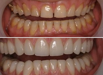 Porcelain Veneers