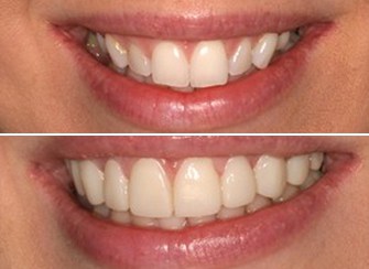 Porcelain Veneers