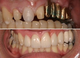 Dental Implants