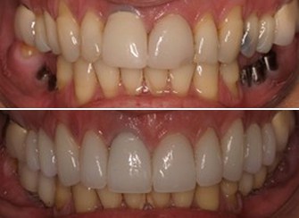 Dental Implants