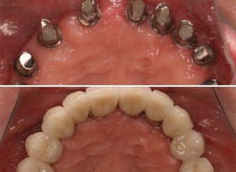 Dental Implants