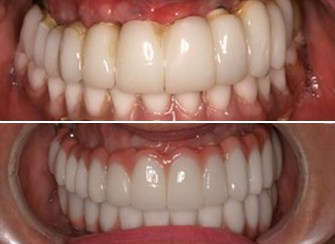 Dental Implants