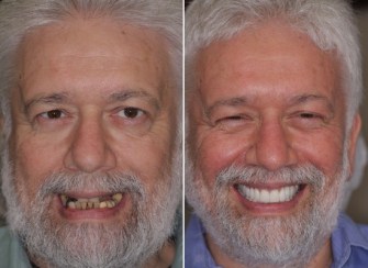 Dental Implants