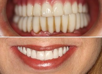 Dental Implants