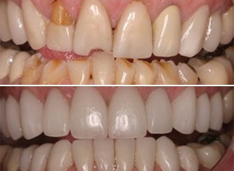 Porcelain Veneers