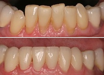 Porcelain Veneers