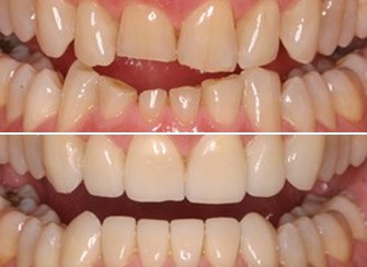 Porcelain Veneers