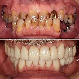 Before & after photo of dental work