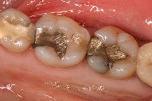Replace your Old Ugly looking Fillings or Crowns
