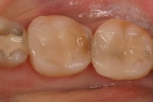 With a NEW Natural Looking Tooth!
